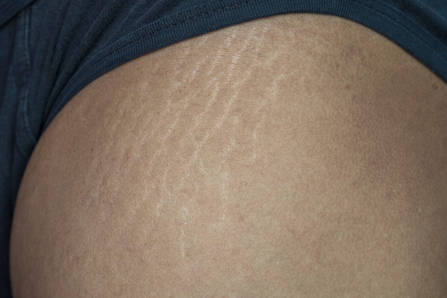 Upper leg and gluteus with stretch marks