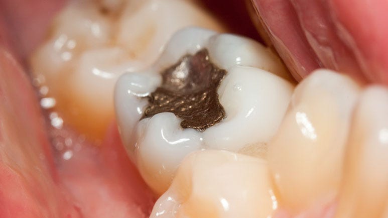 end mercury in dentistry movement gains momentum