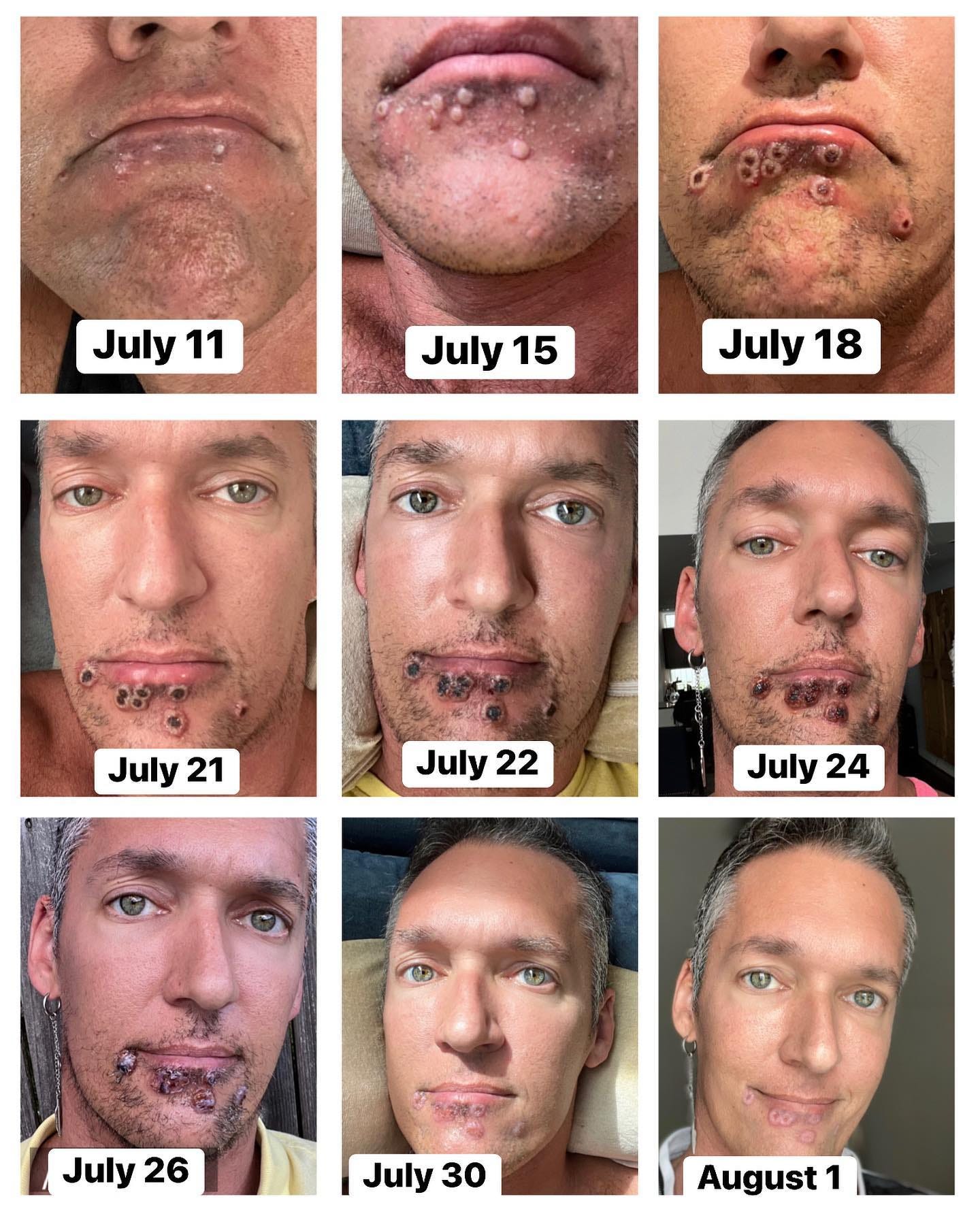 Silver Steele shared these images of how the monkeypox rash developed on his face over around 20 days