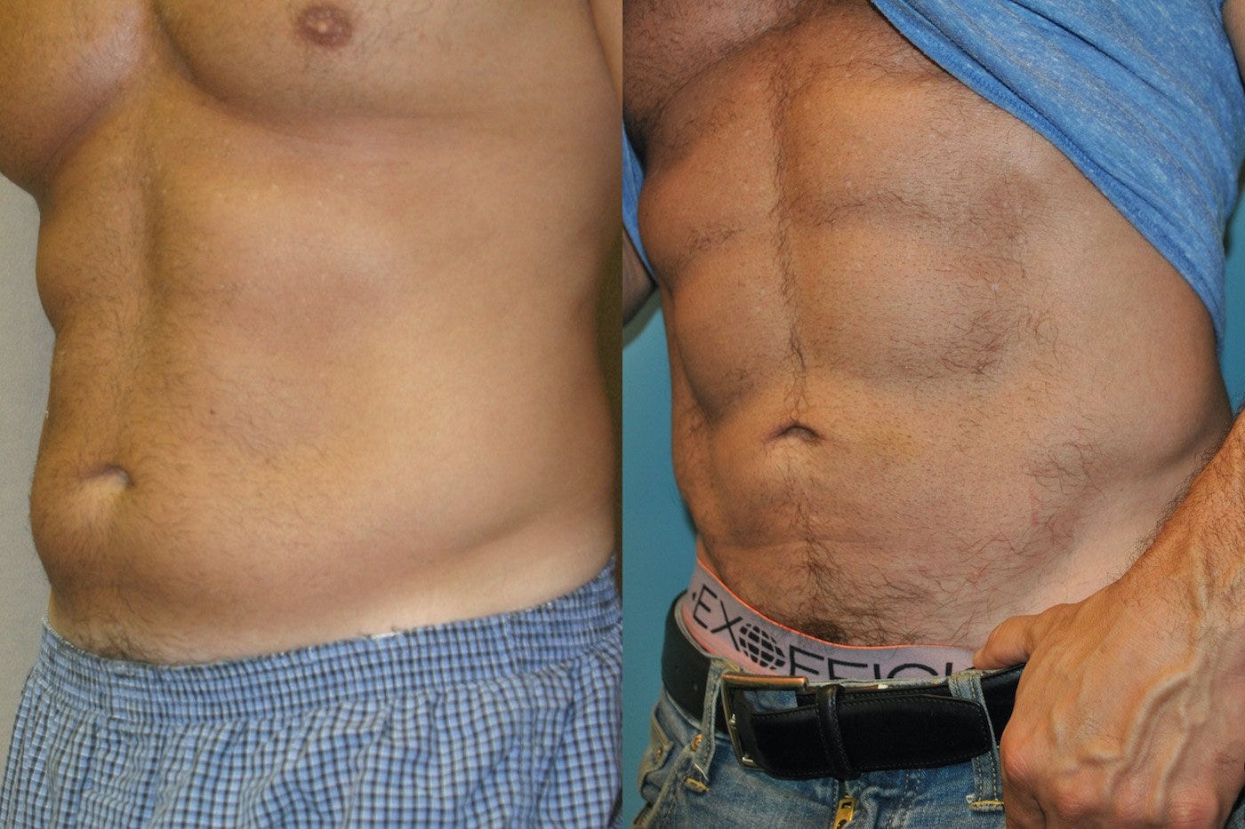 Liposuction Men Before & After | Norwalk, Connecticut - Serving Stamford,  Greenwich, Manhattan, New York, Fairfield and the world.