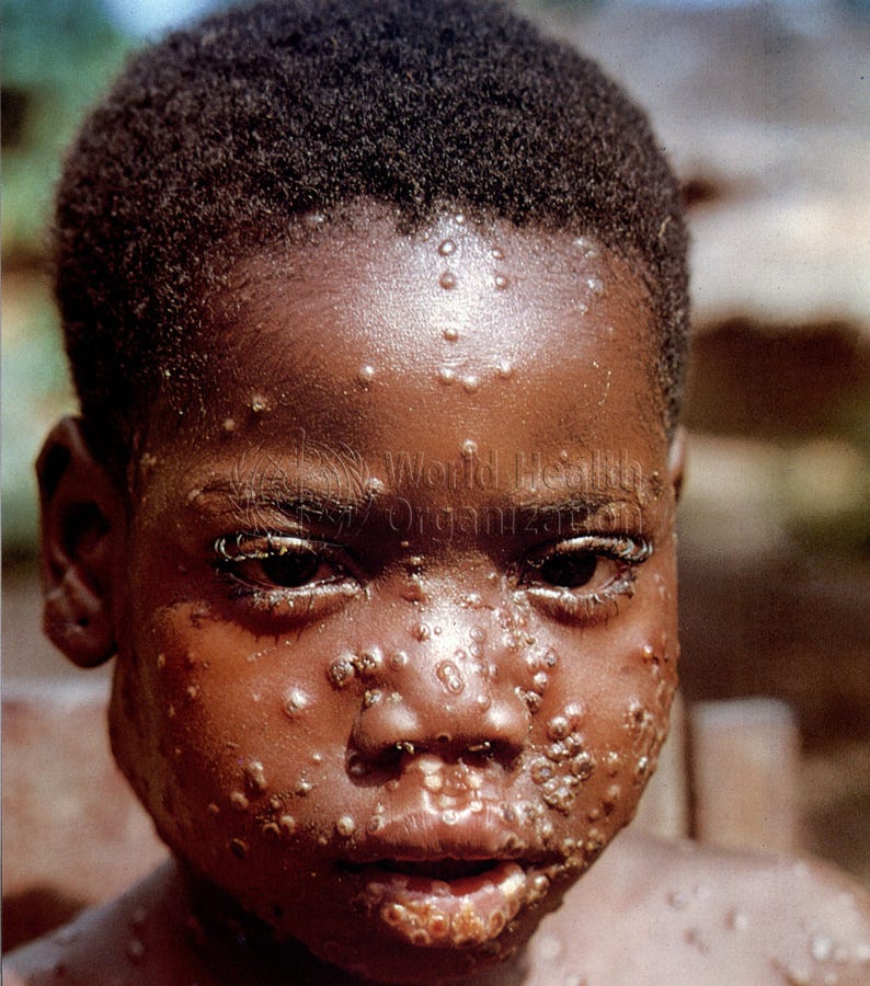 What is Monkeypox?