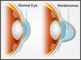 Image result for keratoconus Image result for keratoconus