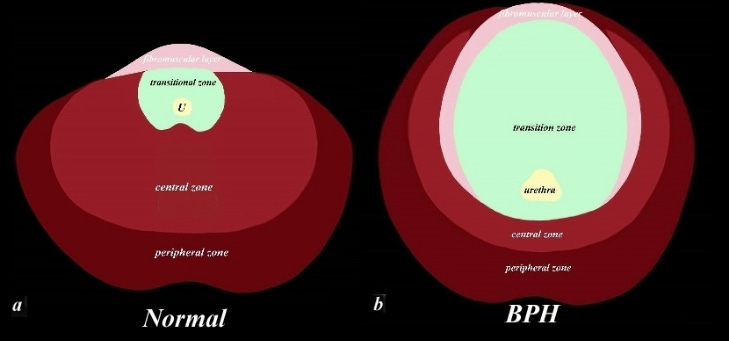 Two top-down prostate cross sections, with BPH tripling the size of the transitional zone in the right figure.