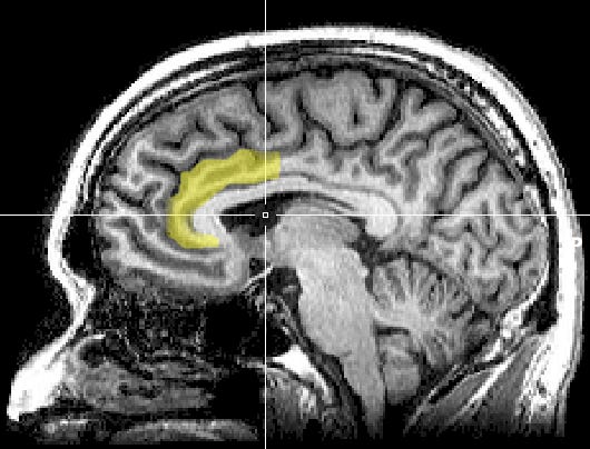 MRI evidence indicates that the greater the psychological conflict signalled by the anterior cingulate cortex, the greater the magnitude of the cognitive dissonance experienced by the person.