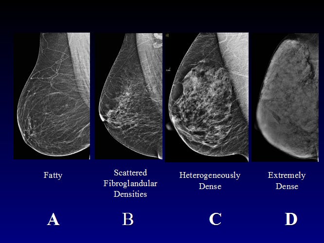 Mammogram photos of 4 levels of breast density in women