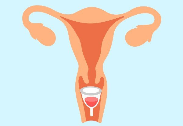 Ilustração de um útero com o copo menstrual posicionado na canal vagina, logo antes do colo do útero