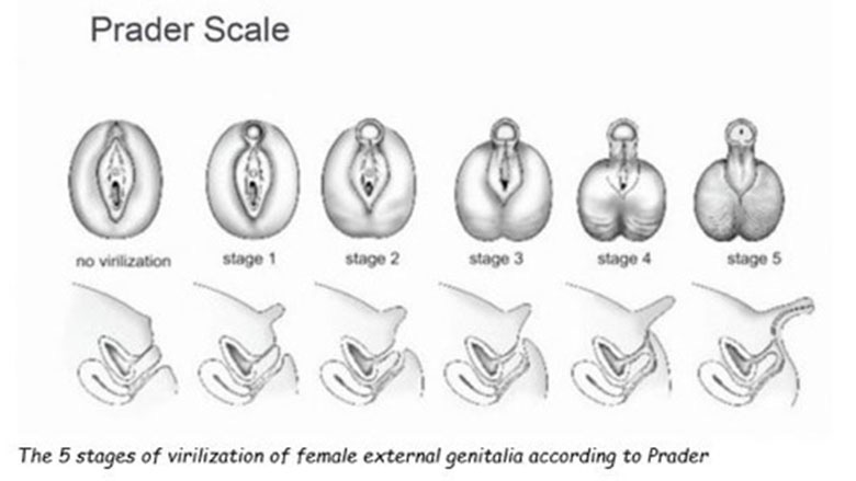 Classic congenital Adrenal Hyperplasia Diagnosed in the Newborn Period |  Children's Hospital of Philadelphia