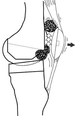 illustration of knee showing fibrous nodule