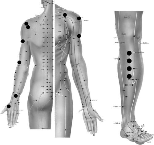 Location Location Location. Acupuncture and chronic shoulder pain - CAM or  Sham? - International Association for the Study of Pain (IASP)