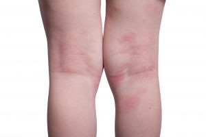 Image of the back of a child's legs showing dry cracked skin behind the knees.