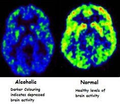 How does alcohol affect your brain? | Ciencia Puerto Rico
