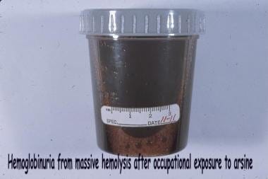"Blackwater" urine due to massive hemolysis, from 