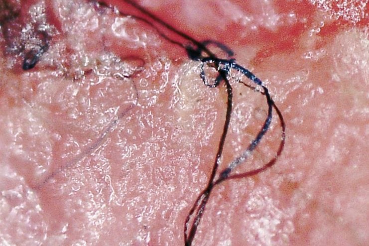Morgellons Syndrome - causes, symptoms and treatment
