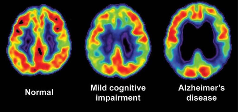 Brain Imaging for Alzheimer's & Dementia | Pacific Brain Health Center