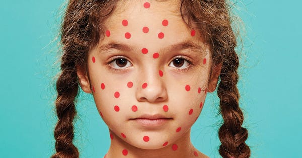 Measles for the One Percent