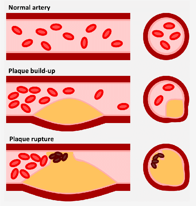 The atherosclerotic plaque. Illustration depicting the progression of... |  Download Scientific Diagram