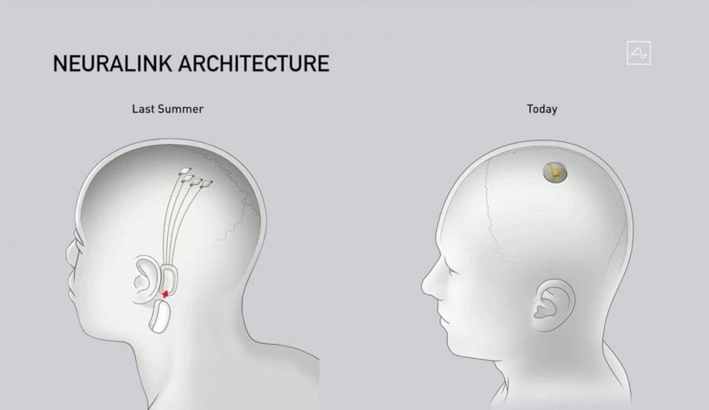 Diagram of neuralink implanted into human skulls