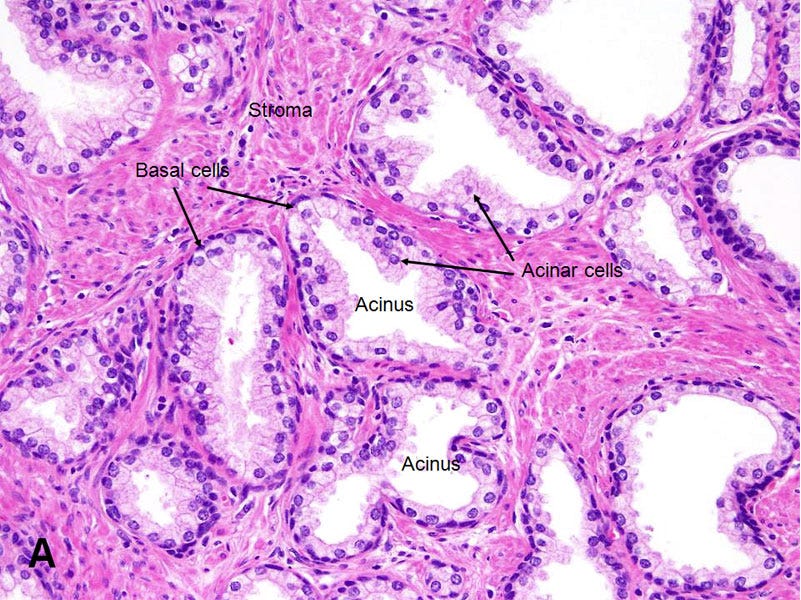 A pinkish photomicrograph whose prominent feature is holes (marked "acinus"). Along the holes' inner periphery are long, pale cells pointing inward (marked "acinar cells") whose bottom edges are in turn ringed by small, dark, flat cells (marked "basal cells.") The background is a fairly homogeneous, faintly striated region marked "stroma."