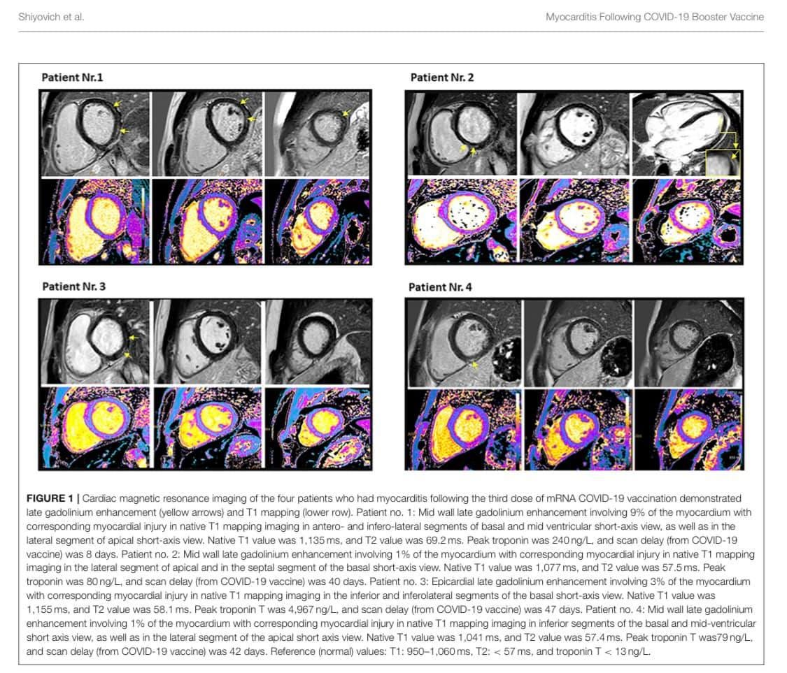 May be an image of text that says 'Shiyovich tal Patient Nr.1 Myocarditis Following COVID-1 Booster Vaccine Patient r.2 P”tr.3 Nr.3 Patient Nr.4 FIGURE Cardiac magnetic resonance imaging gadolinium corresponding segment was Patient myocarditis following lower mapping maging Native value was dose with segments vaccination demonstrated ventricular 8.1m troponin imaging inferior 2value 1% the segment (from COVID- 19 accine COVID-19 native mapping days. Reference Epicardial inferolatera segments COVID-1 accine) native mapping imaging 041ms, and 060ms values: basal view. Native value days. .4: id lla gadolinium segments value 4ms.Peak troponin 13ng/L.'