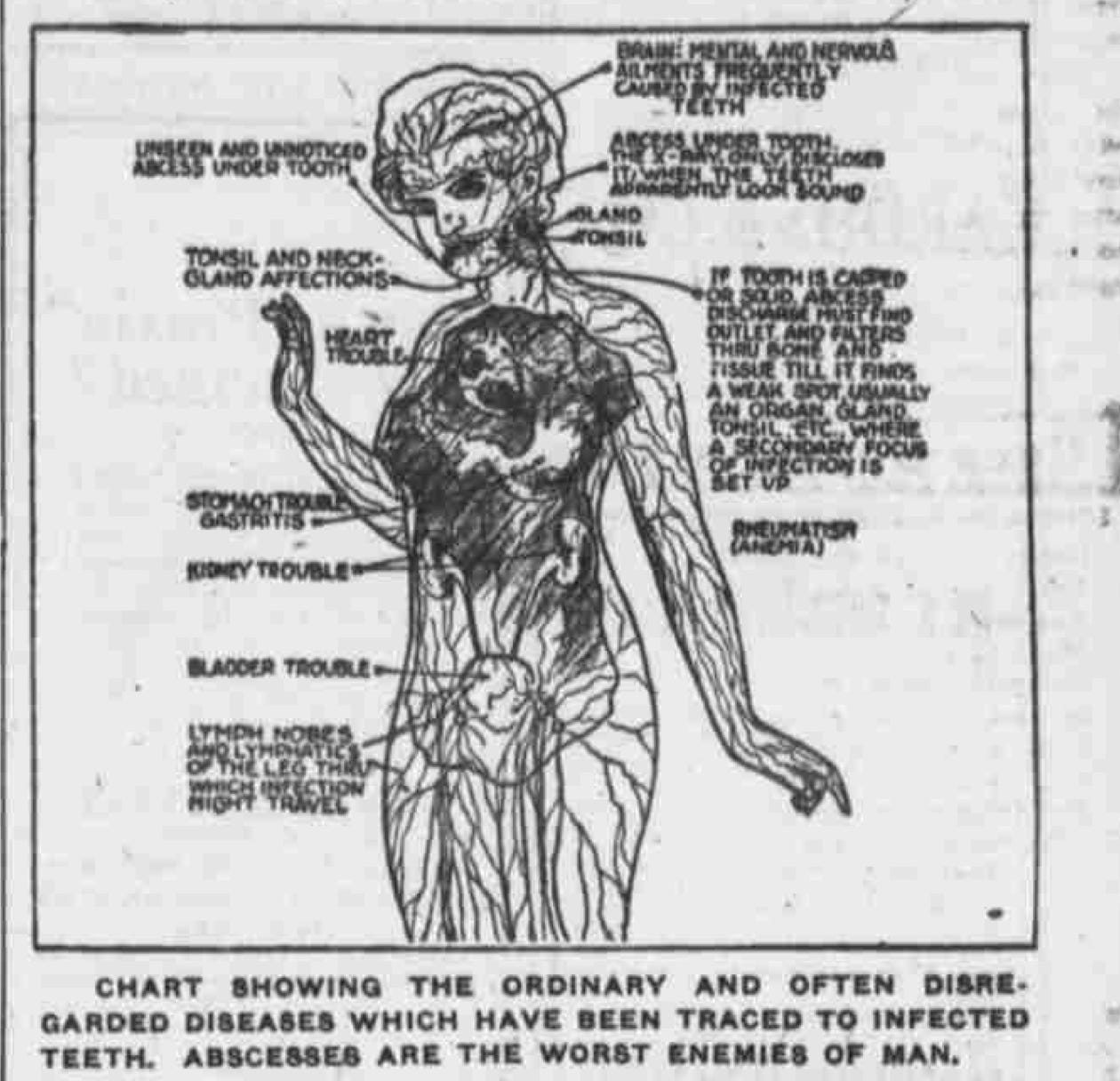 Newspaper graphic shows a woman's nervous system with the various diseases caused by tooth infections. It includes "mental and nervous disorders."