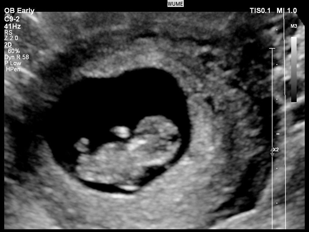Ultrasound In Pregnancy - Women's Ultrasound Melbourne