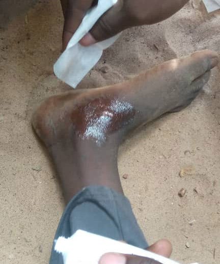 Patrick treats a minor injury with a topical antibacterial sent to him by a certain benefactor in the U.S. It’s worth noting that even a minor scrape like this can become a serious concern in a country where clean water is not at all certain.