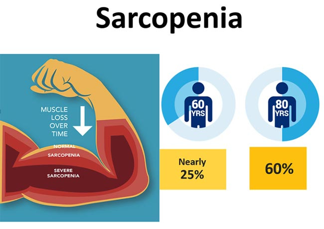 sarcopenia