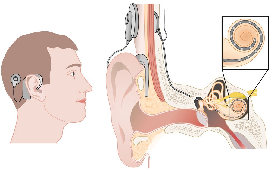 Personalised strategies for cochlear implant surgery and hearing  rehabilitation | by Research Outreach | Nov, 2022 | Medium