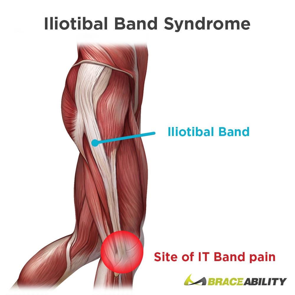 Iliotibial Band Syndrome | IT Band Stretchs, Exercises & Treatment
