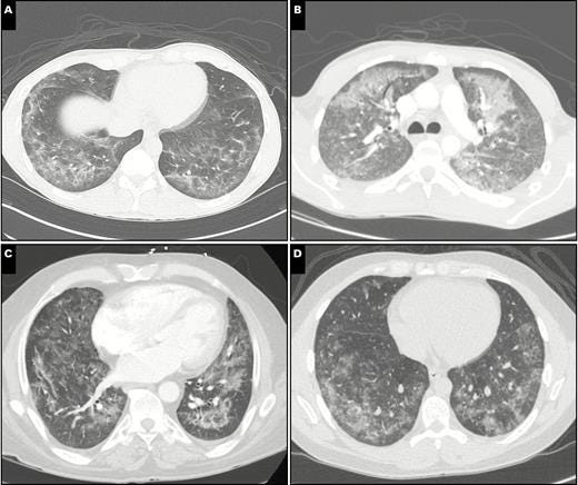 Chest computed tomography findings in severe pulmonary disease associated with e-cigarette use (vaping). A, Case 1: diffuse bilateral ground-glass opacities with peripheral prominence, mimicking eosinophilic pneumonia. B, Case 2: diffuse bilateral ground-glass opacities with areas of consolidation. C, Case 4: bilateral basilar dependent consolidations with diffuse ground-glass opacities and mild smooth septal thickening. D, Case 6: bilateral ground-glass opacities in a somewhat patchy distribution.
