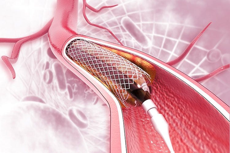 What is a stent and why would you need one? | Edward-Elmhurst Health