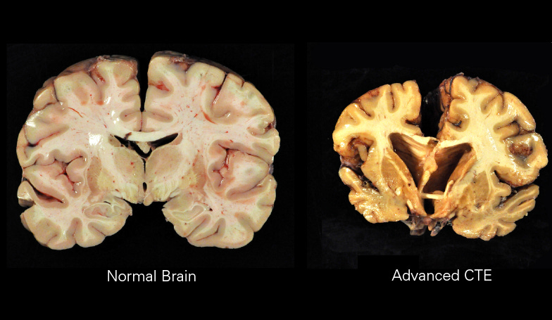 normal brain vs. cte brain