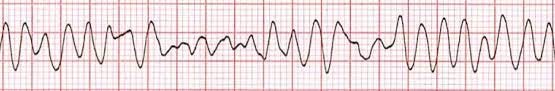 Ventricular Fibrillation training - ACLS Cardiac Rhythms video | ProACLS