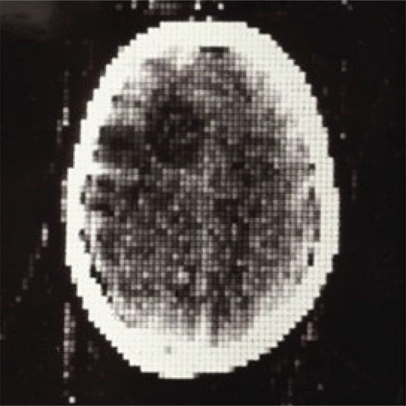 Figure 8.2. The first clinical CT scan, acquired October 1971 at Atkinson Morley’s Hospital in London.