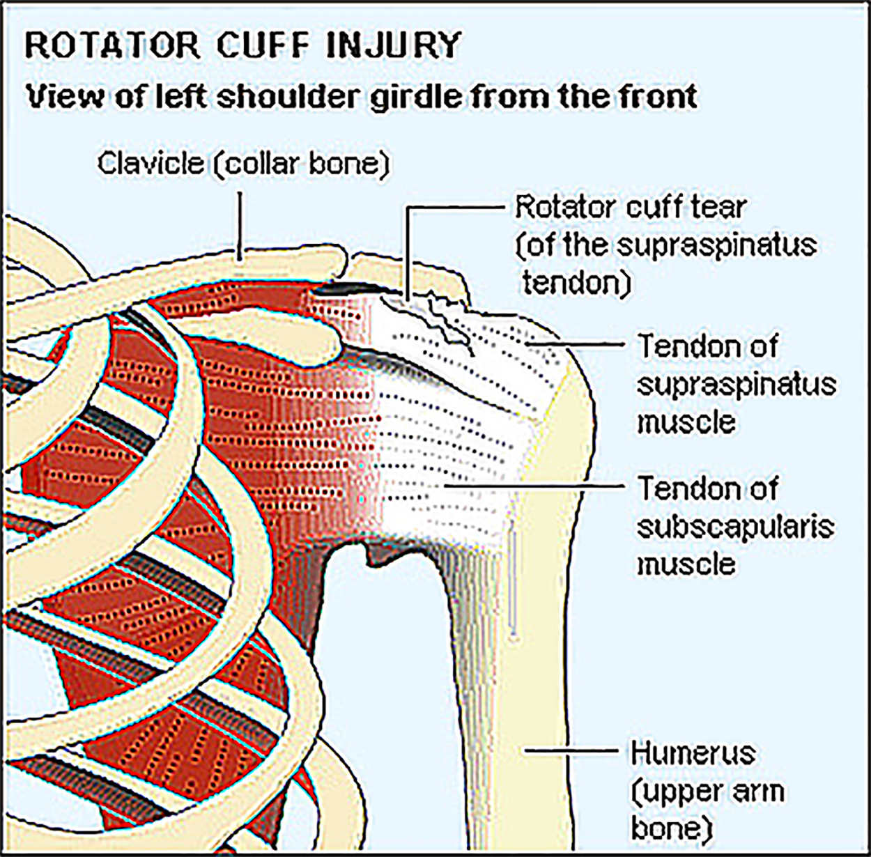 https://dynamicphysiotherapy.ca/wp-content/uploads/2019/08/Rotator-Cuff-21.jpg