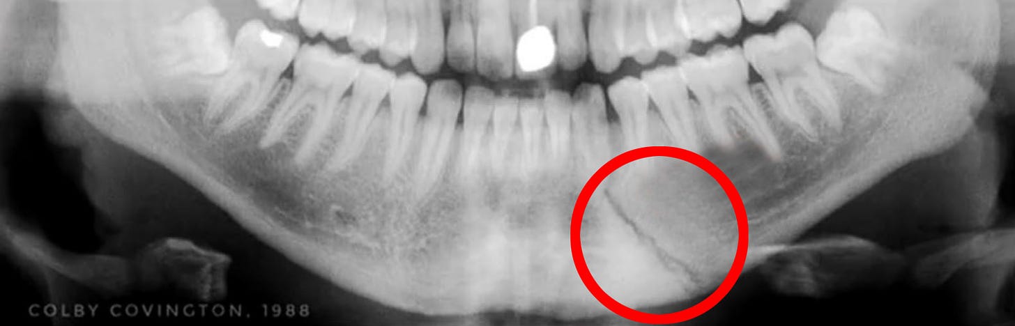  This is the X-Ray of Colby Covington's jaw after he had it brutally broken