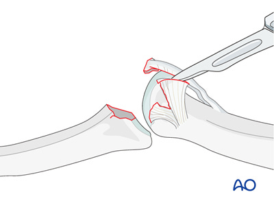 illustration of incising collateral ligament