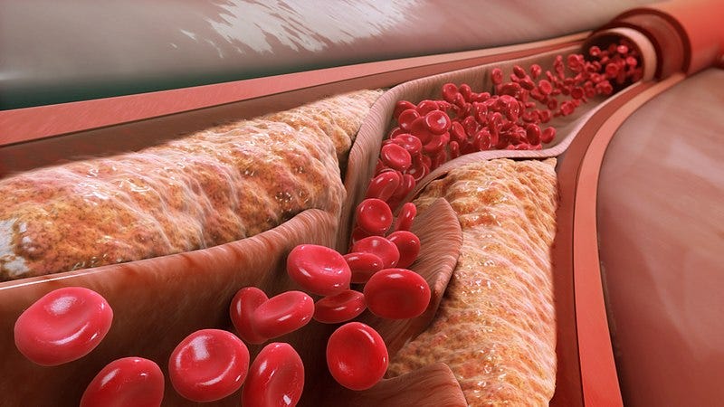 cholesterol plaque buildup