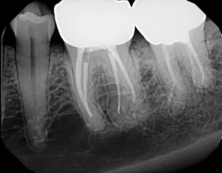 x-ray of teeth showing molars with root canals. The teeth have extra roots that are also curly.