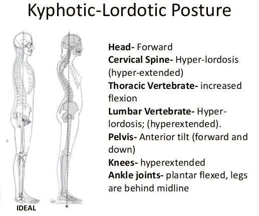 What are some exercises I can do to get rid off my Kyphotic-Lordotic  posture? : Posture