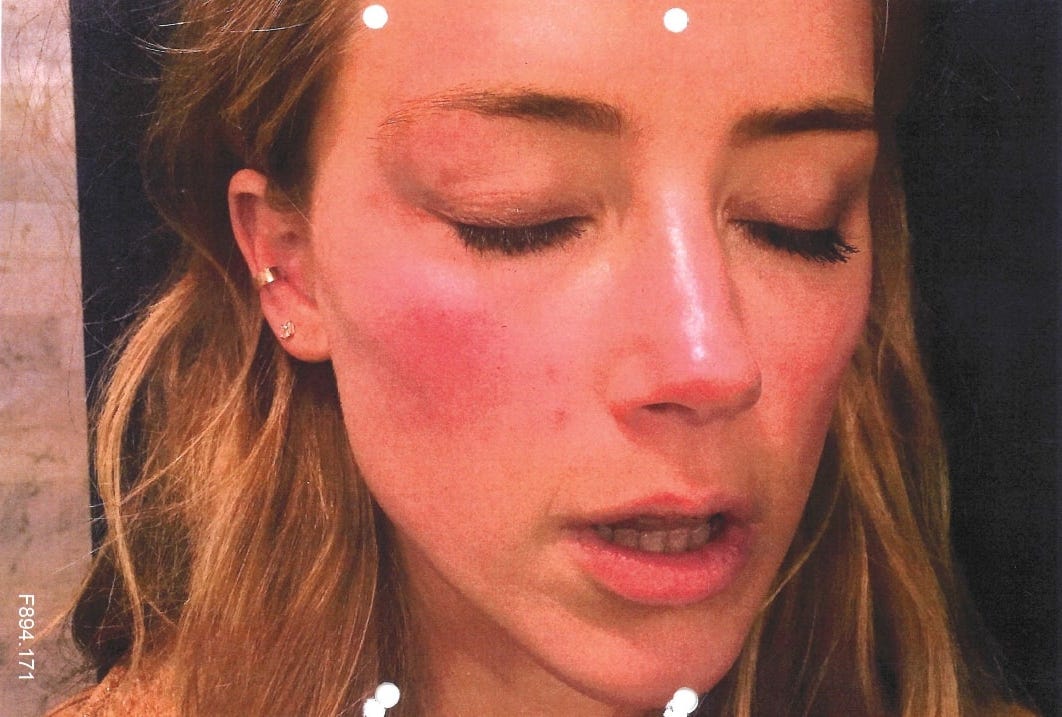 New pictures show Amber Heard's 'bruised face' after Johnny Depp 'threw a  phone at her'