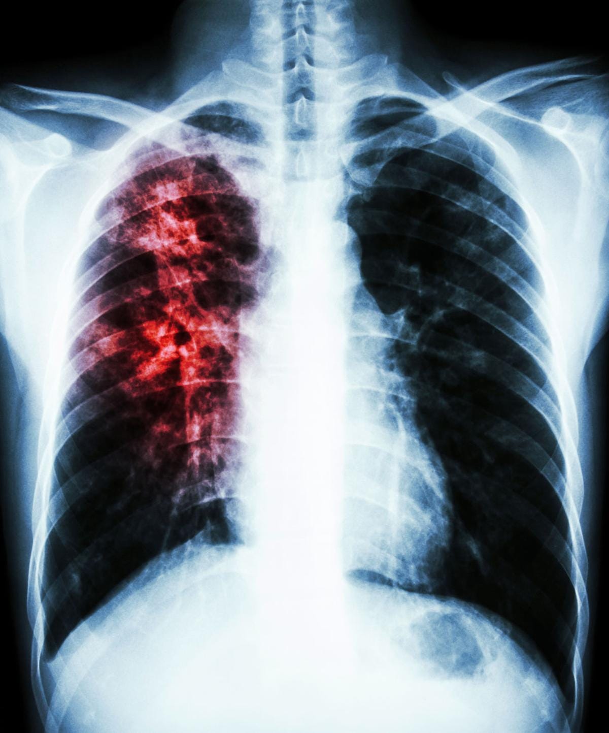 Tuberculosis case reported in Syracuse school district ...