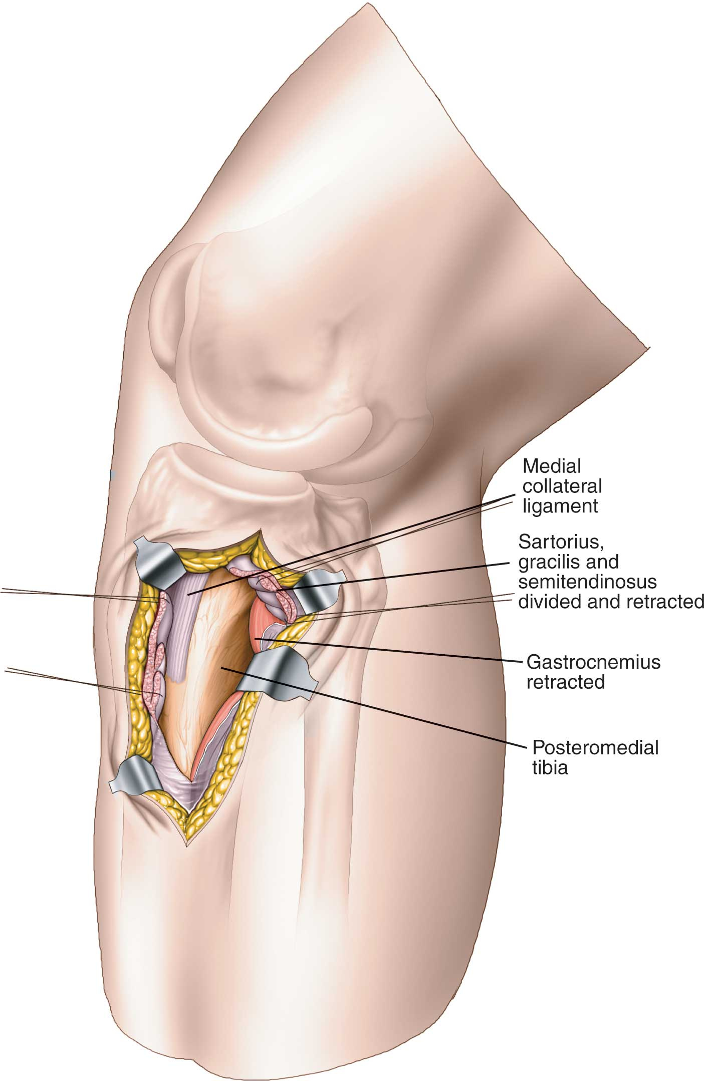 medical illustration of knee surgery