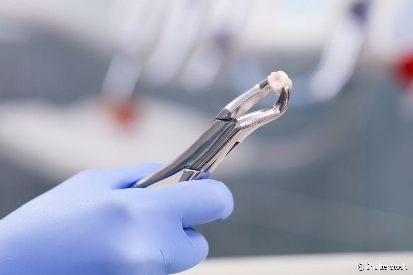 Extração de dente para o implante dentário: como ocorre esse procedimento?