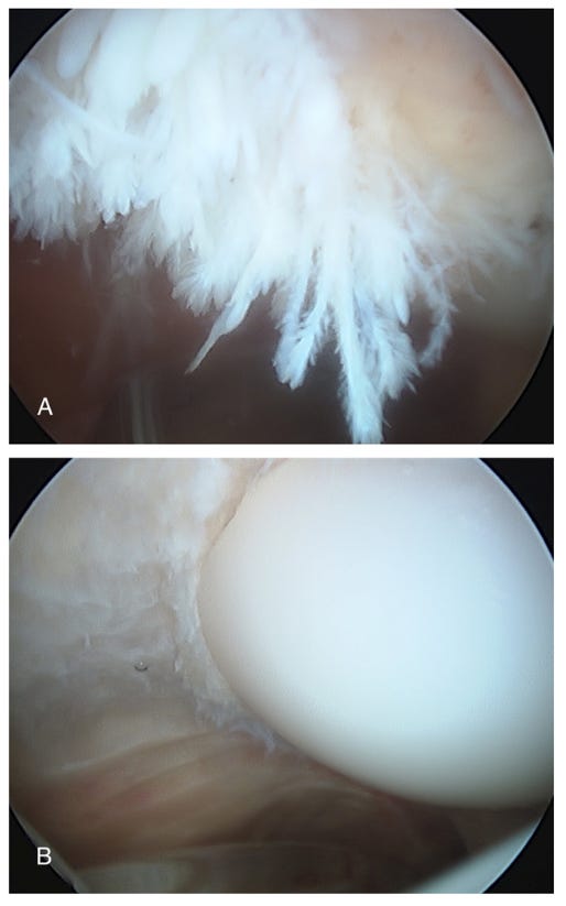 arthroscopy images of knee showing before and after resection