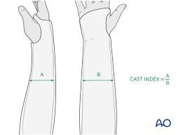 Closed reduction; cast fixation with/without wedging for 22-D - Both bones,  combination of radial and ulnar fracture