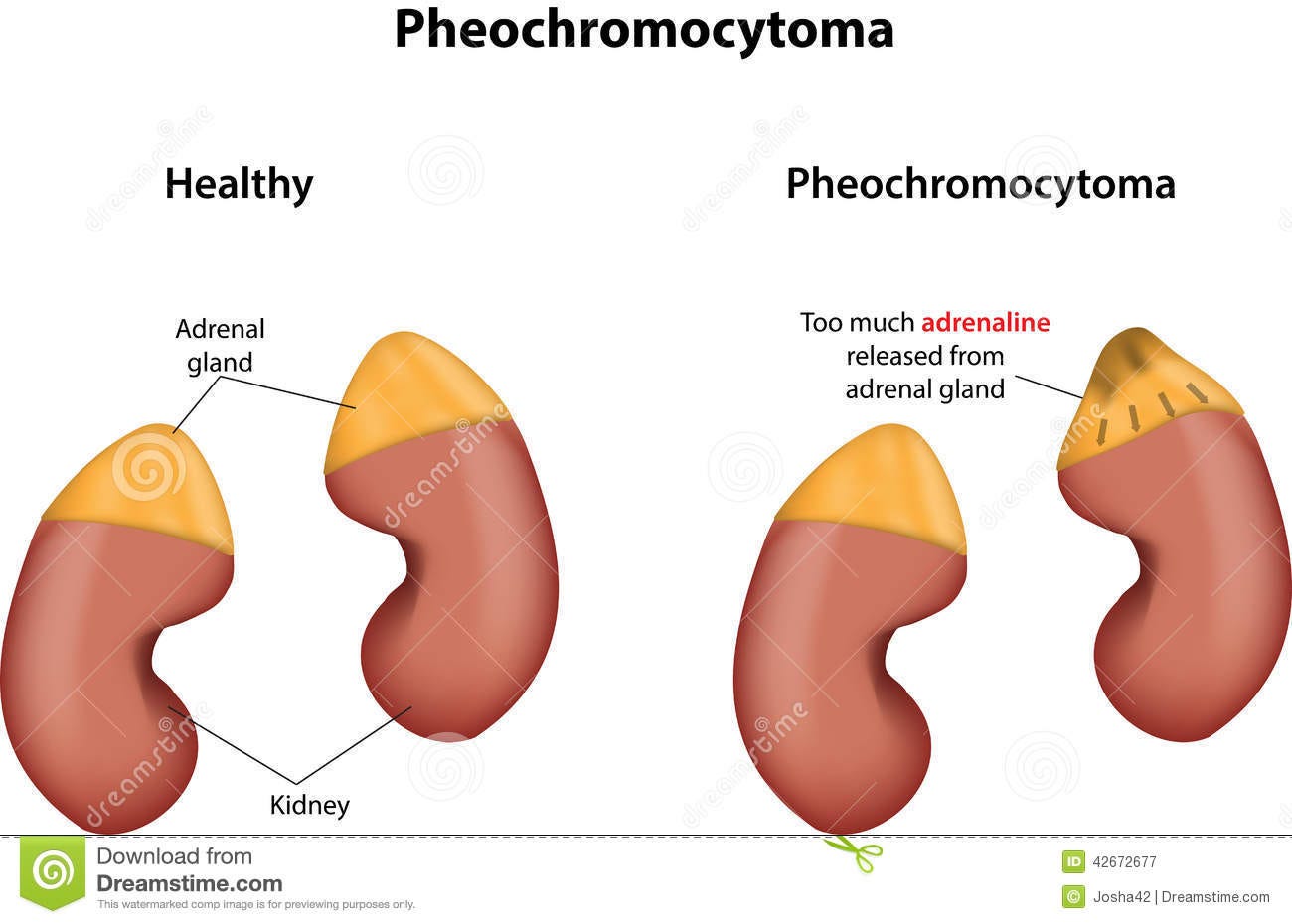 Pheochromocytoma Stock Vector - Image: 42672677
