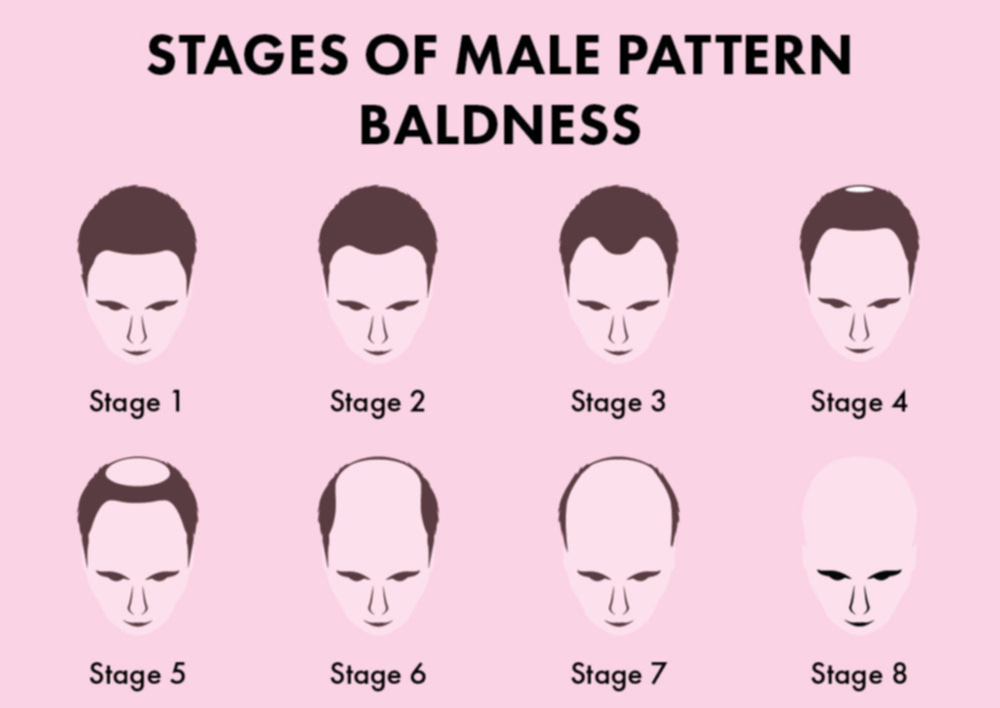 Male Pattern Baldness: Causes, Prevention &amp; The Best Treatments | Blog |  HUDA BEAUTY