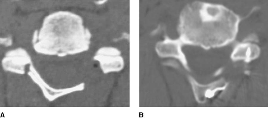 axial CT of laminoplasty