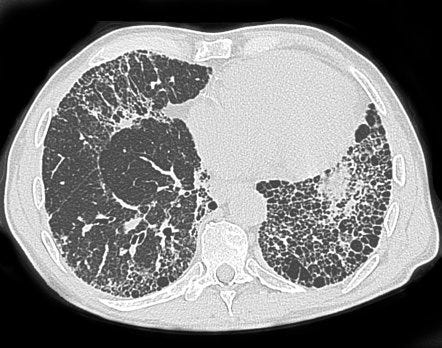 Honeycombing (lungs) | Radiology Reference Article | Radiopaedia.org